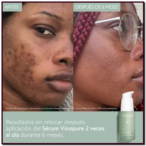 CAUDALIE los beneficios de la vid para el tratamiento y cuidado de la piel. El Sérum Salicílico Anti Imperfecciones Vinopure reduce las imperfecciones, desincrusta y minimiza los poros. 